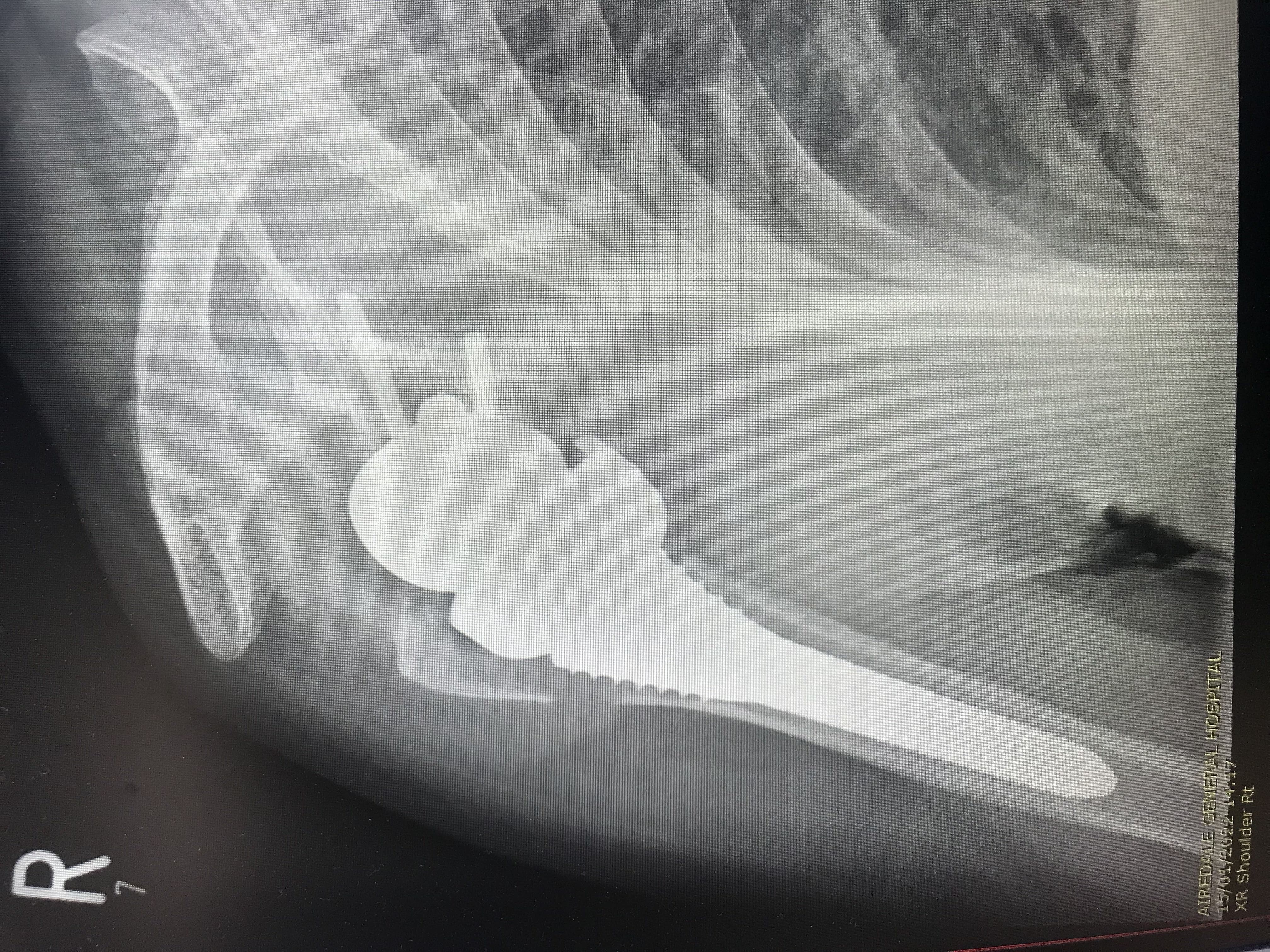 X-Ray of Knee Replacement 1